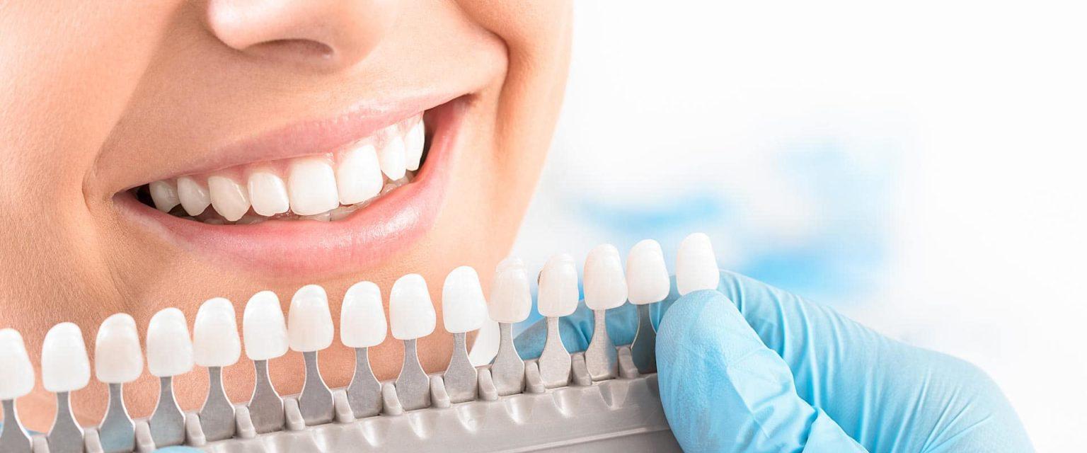 Bleaching dentist Zurich